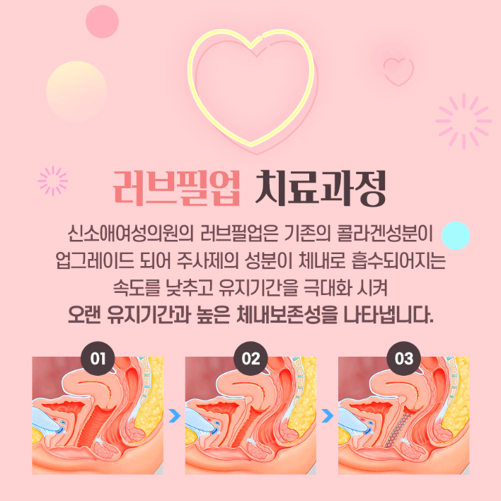 러브필업 질필러 치료 과정