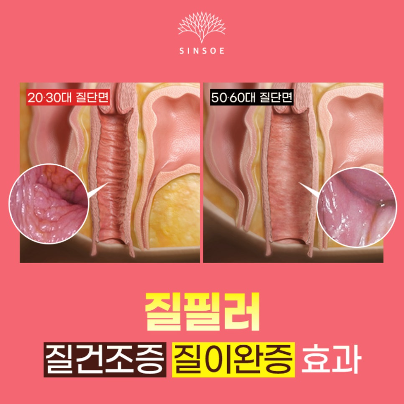 질필러 시, 질건조증과 질이완증 개선에 도움이 될 수 있을까?