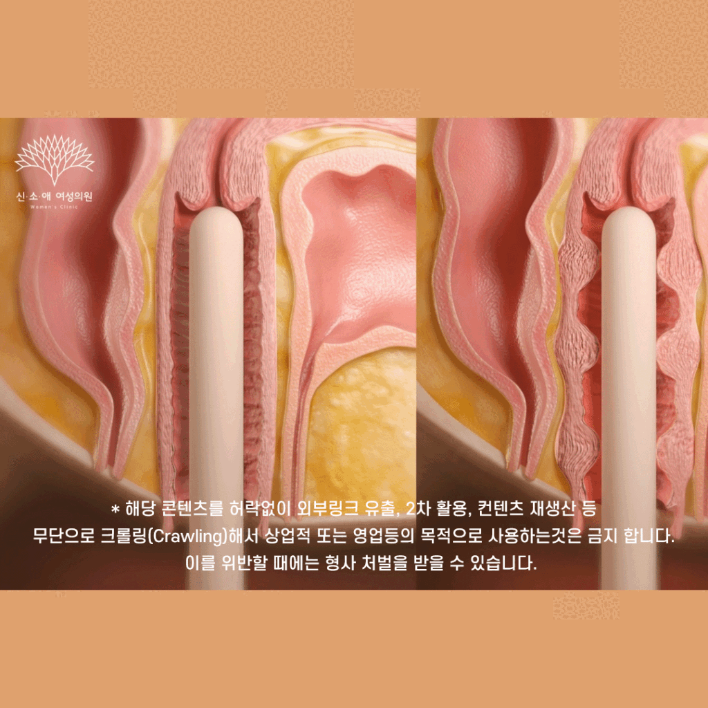 질건조증과 질이완증 개선에 도움이 될 수 있는 질필러 1