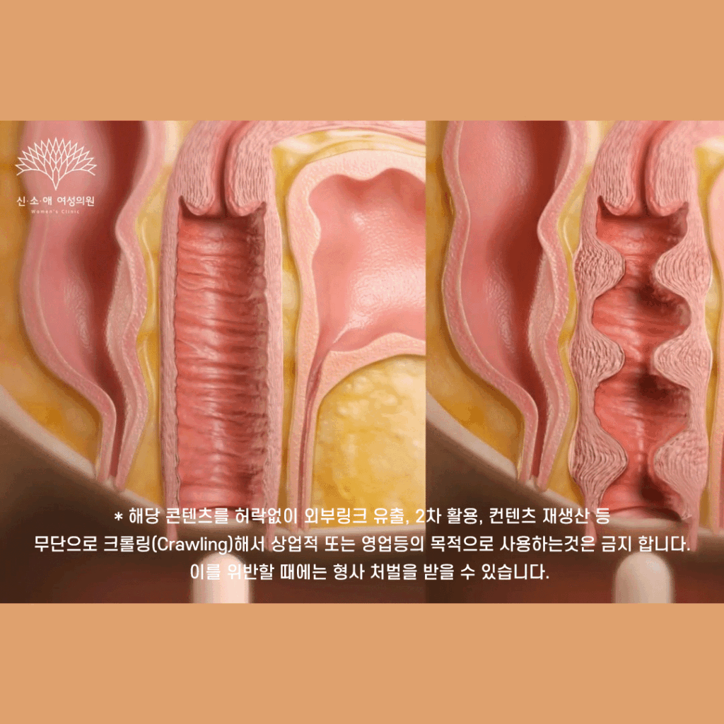 질건조증과 질이완증 개선에 도움이 될 수 있는 질필러